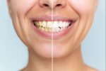 post whitening care mistakes teeth