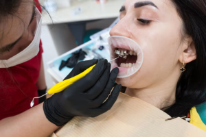 How Do Dental Sealants Prevent Cavities