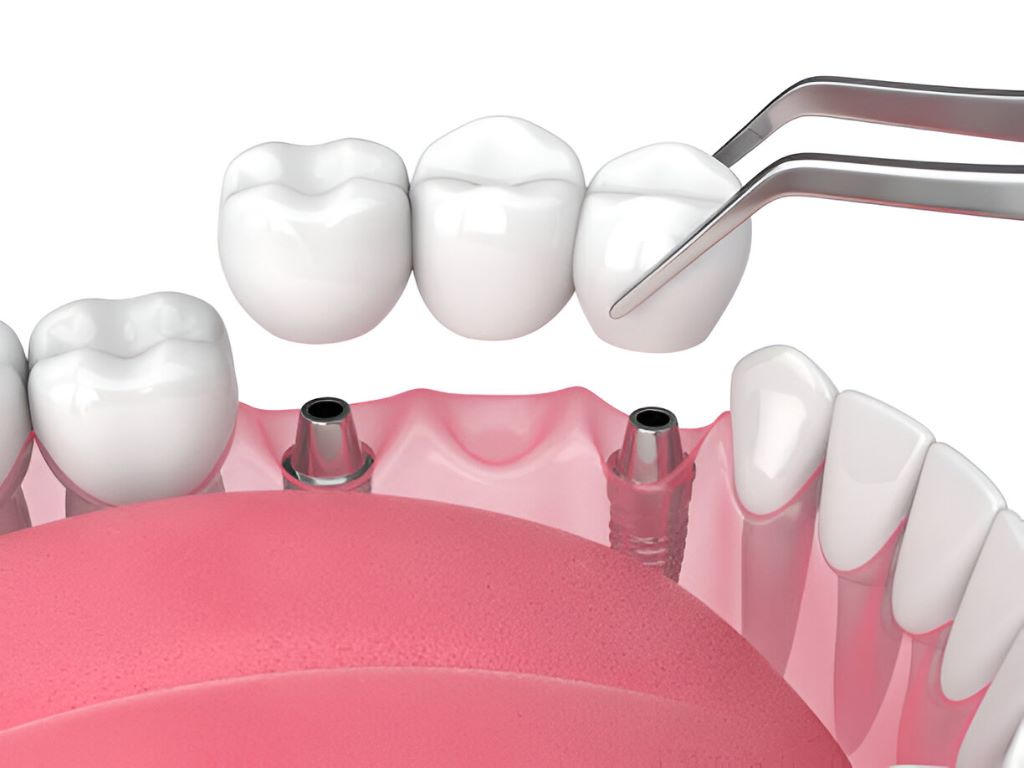 Crowns and Bridges Lakefield