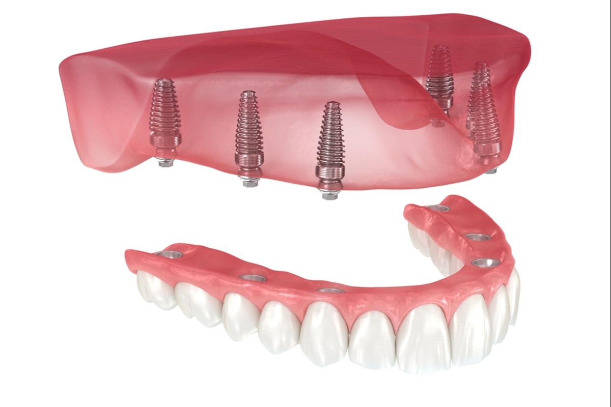 dental Implant and dentures in lakefield