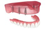 dental-implant-vs-dentures-for-seniors-which-is-better
