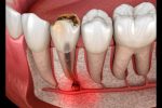 root canal therapy in lakefield