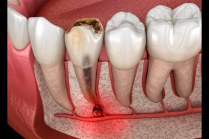 root canal therapy in lakefield