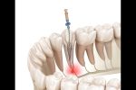 root canal therapy in lakefield