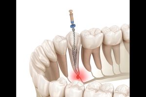 root canal therapy in lakefield
