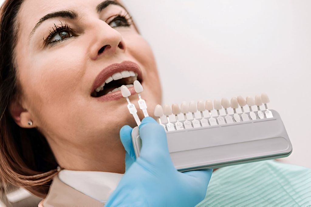 porcelain veneers lakefield