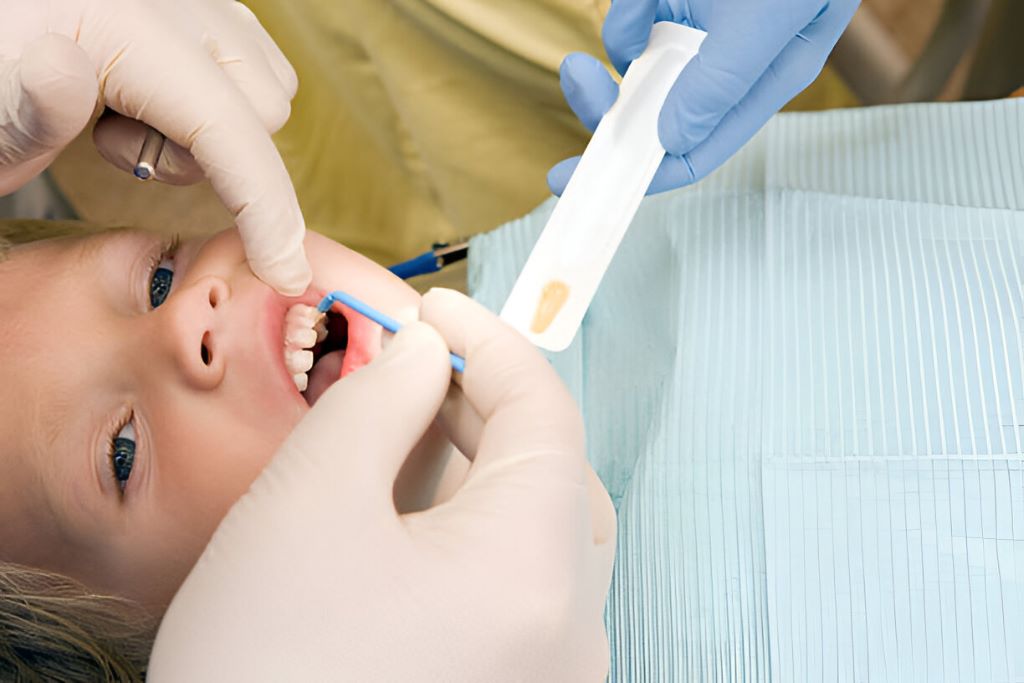 silver diamine fluoride lakefield