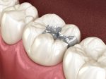 what is silver diamine fluoride and how does it stop tooth decay without a drill