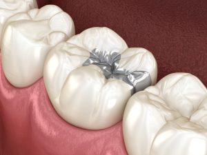 what is silver diamine fluoride and how does it stop tooth decay without a drill